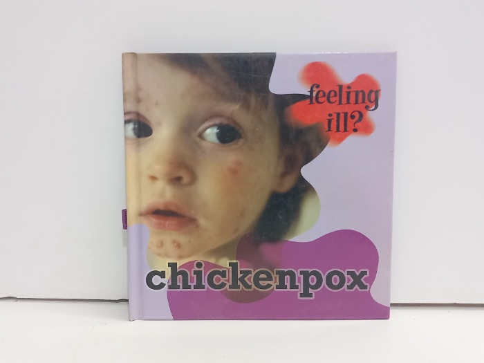 Chickenpox