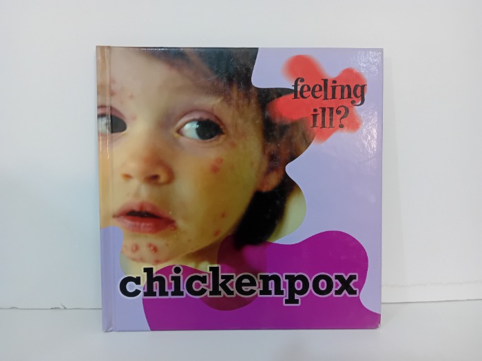 chickenpox
